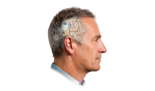 AI-Guided Brain Implant for Memory Loss Gets FDA Breakthrough Status