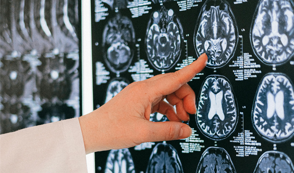 FDA Clears AI That Flags Early Stroke Damage on Routine Brain CT Scans