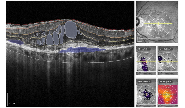 RetinAI and Boehringer Ingelheim Collaborate on …